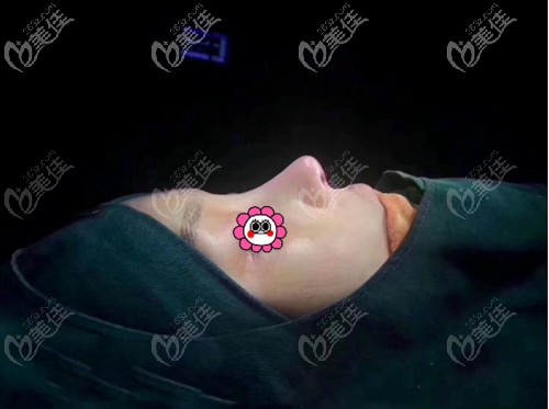 耳軟骨隆鼻失敗修復前后 耳軟骨隆鼻失敗修復前后