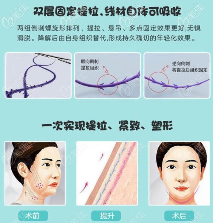 太原時光埋線提升術優(yōu)勢