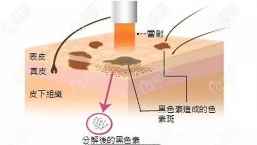 伍遠(yuǎn)紅醫(yī)生在激光祛斑上經(jīng)驗(yàn)豐富 伍遠(yuǎn)紅醫(yī)生在激光祛斑上經(jīng)驗(yàn)豐富