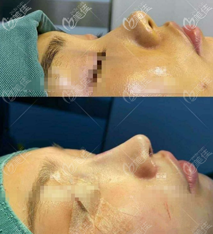 重慶美萊鼻整形好的醫(yī)生李任美人魚尾鼻案例