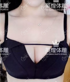 北京項(xiàng)力源豐胸好嗎?我找她做的脂肪豐胸術(shù)后效果反饋給你