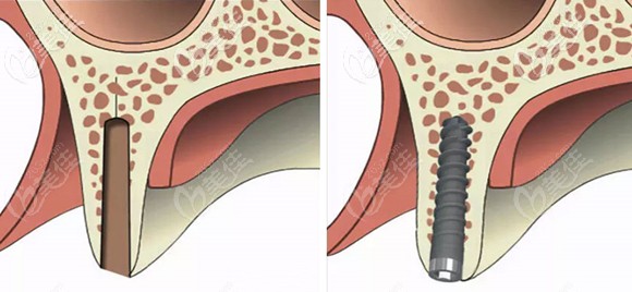 做了骨劈開和沒做骨劈開對(duì)比 做了骨劈開和沒做骨劈開對(duì)比