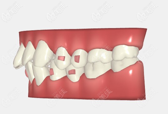 廖正宇醫(yī)生的正畸小科普 廖正宇醫(yī)生的正畸小科普