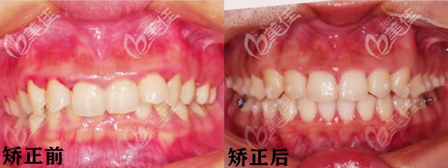 戴隱適美牙套是什么樣的體驗(yàn)？我做完隱形矯正后效果很滿意！