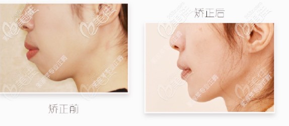 郭淑蘋院長的矯正案例