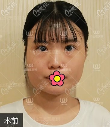 杭州連天美醫(yī)院高俊明醫(yī)生下頜角截骨前 杭州連天美醫(yī)院高俊明醫(yī)生下頜角截骨前