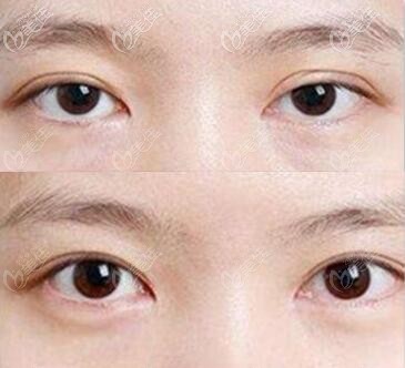 真人雙眼皮修復(fù)前后對比照片 真人雙眼皮修復(fù)前后對比照片