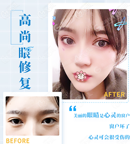 余文林醫(yī)生雙眼皮修復技術怎么樣