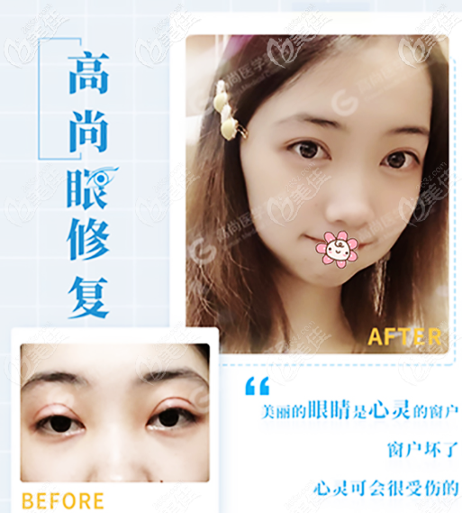 廣州高尚余文林雙眼皮修復怎么樣