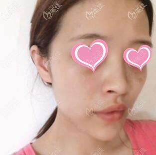 注射隆鼻術(shù)后第2天