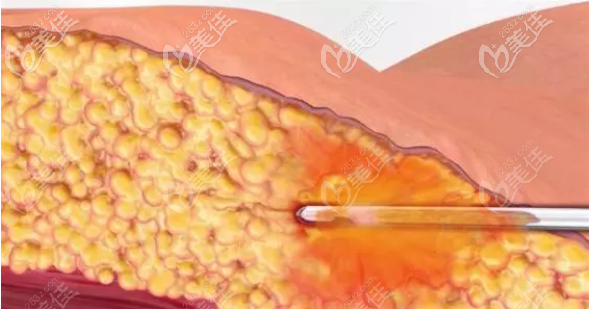 <!--<i data=20240703-sp></i>-->可以做5G天使光雕吸脂手術有哪些 醫(yī)院