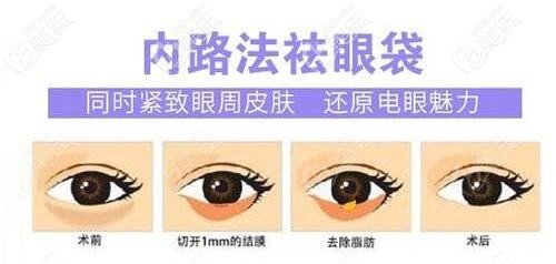 內(nèi)路法去眼袋