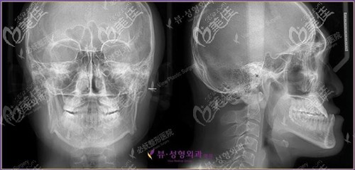骨性凸嘴拍片效果