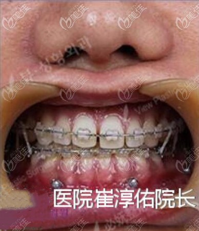 骨性地包天手術(shù)后牙齒矯正