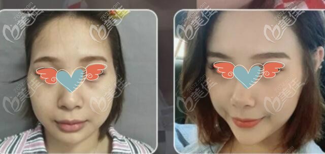 面部脂肪加減法真實(shí)案例術(shù)前術(shù)后對(duì)比效果圖 面部脂肪加減法真實(shí)案例術(shù)前術(shù)后對(duì)比效果圖