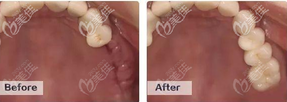廣州中家醫(yī)家庭口腔醫(yī)院免費(fèi)種植牙怎么樣