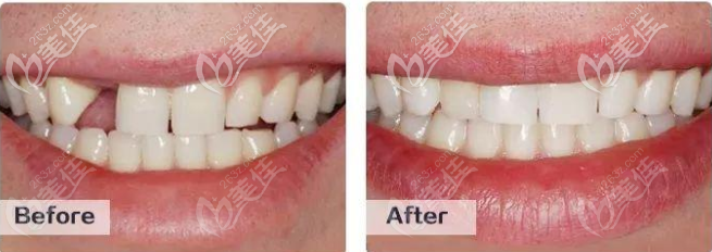 廣州中家醫(yī)家庭口腔種植牙怎么樣