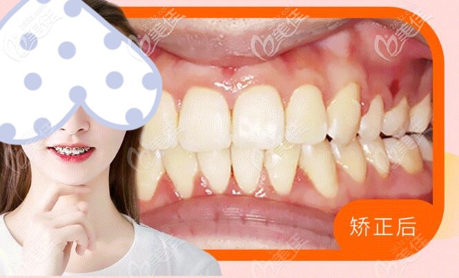 矯正前后對(duì)比照