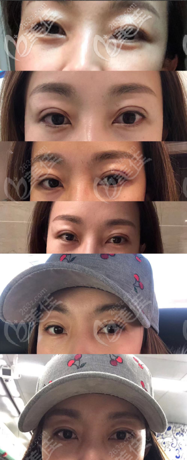 廣州華美醫(yī)療美容整形醫(yī)院郝永生術(shù)前照片1