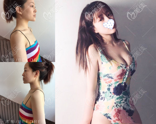 LZ自體生長脂肪細胞豐胸效果圖