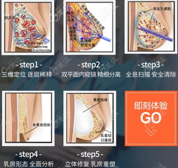 武漢仁愛時光包濤院長胸部奧美定取出