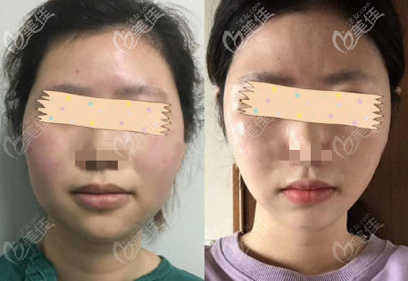 重慶軍美面部雙下巴吸脂術(shù)后半年對(duì)比效果圖 重慶軍美面部雙下巴吸脂術(shù)后半年對(duì)比效果圖