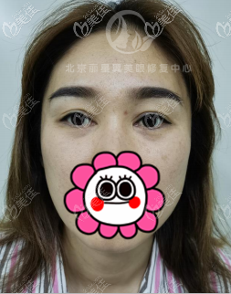 我在北京麗星翼美做內(nèi)眼角修復(fù)前 我在北京麗星翼美做內(nèi)眼角修復(fù)前