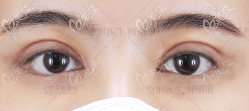 不知不覺(jué)在北京豐聯(lián)麗格修復(fù)雙眼皮第7天了