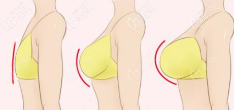 自體脂肪豐胸