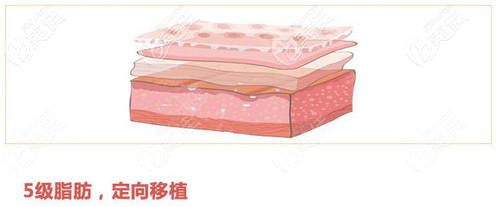 5級(jí)脂肪定向移植