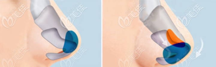 軟骨疊片支架法