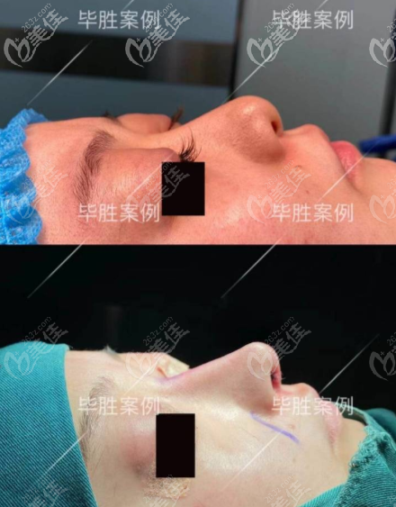 重慶好美畢勝肋軟骨鼻綜合案例