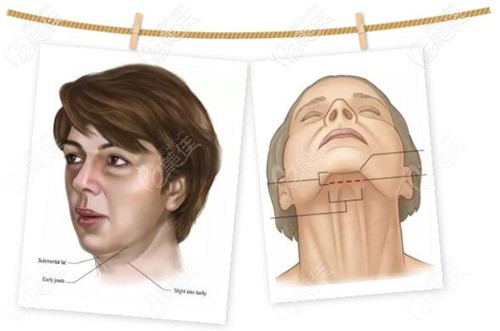 頸闊肌提升的下巴切口位置 頸闊肌提升的下巴切口位置