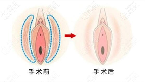 下身外陰撕裂縫合前后效果對(duì)比圖