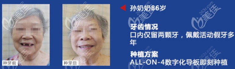 在做過(guò)全口即刻種植牙的叔叔阿姨們都怎么樣了？