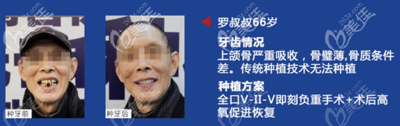 羅叔叔的即刻種植牙前后對比圖 羅叔叔的即刻種植牙前后對比圖