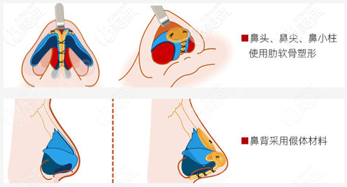 朱家旭肋骨鼻的技術(shù)特點