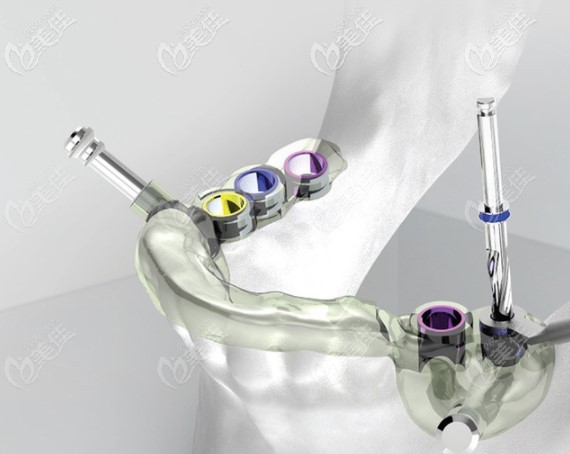 數(shù)字化導(dǎo)板種植牙技術(shù)演示 數(shù)字化導(dǎo)板種植牙技術(shù)演示