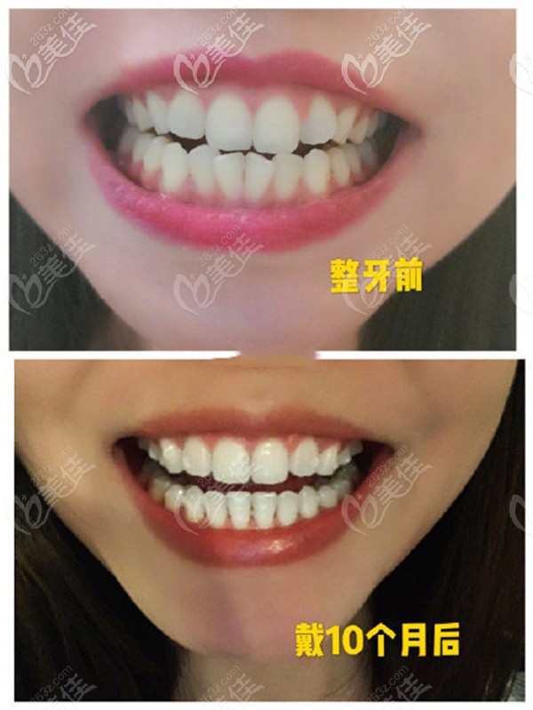 淮安牙知道口腔隱形矯正效果