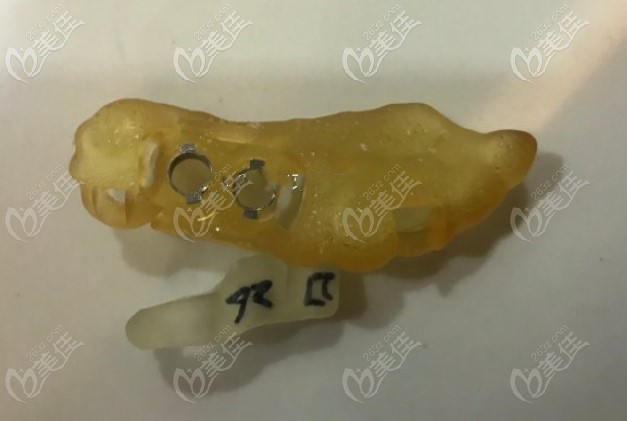 雅悅齒科種牙時使用的種植導板