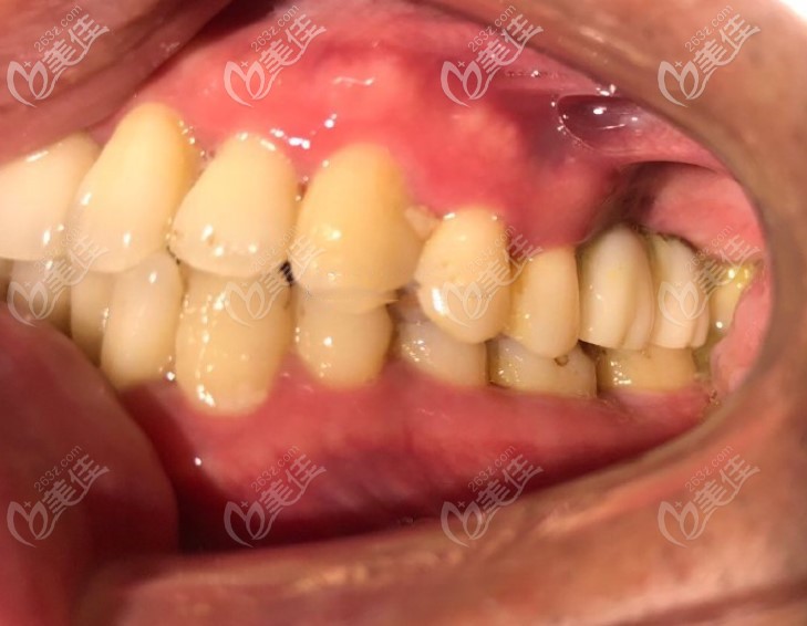 牙槽骨骨量不足照樣做了即刻種植牙,不過雅潔口腔的王杰院長給植了0.5g骨粉