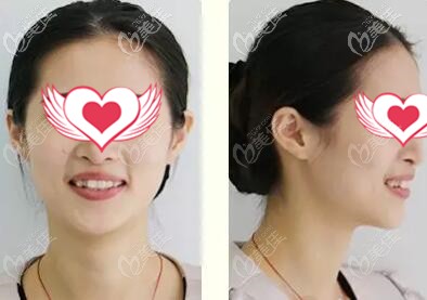 南山麥芽口腔時代天使正畸案例 南山麥芽口腔時代天使正畸案例