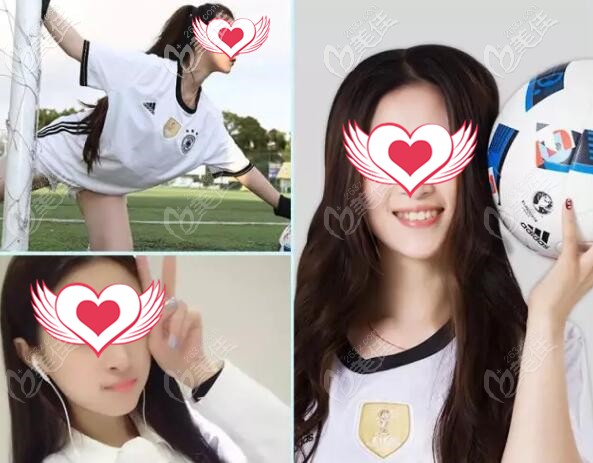 在深圳南山麥芽口腔做時(shí)代天使隱形矯牙(拔智齒+磨牙遠(yuǎn)移),歷經(jīng)2年效果看得見