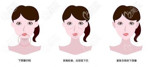 下頜緣提升的必要性