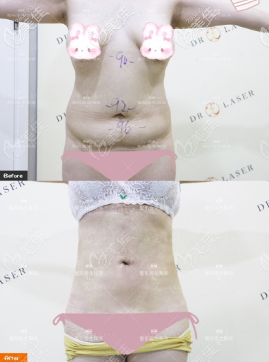 重慶光博士鉆石光雕腰腹吸脂案例效果圖
