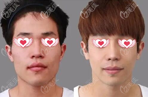 韓國原辰面部綜合整形真人前后對比照 韓國原辰面部綜合整形真人前后對比照