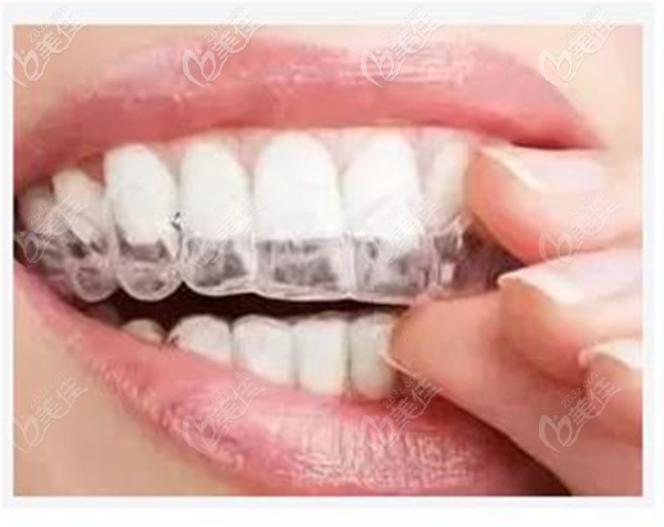 隱形牙齒矯正有非常好的舒適度和美觀度