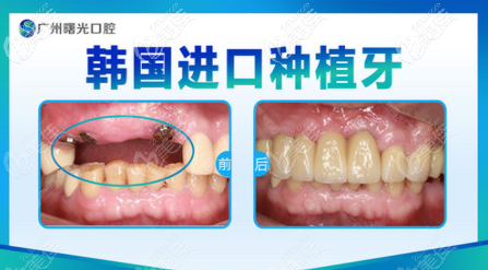 廣州曙光口腔醫(yī)院種植牙怎么樣