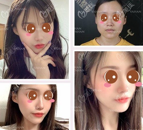 趙貴慶長(zhǎng)曲線下頜角手術(shù)案例