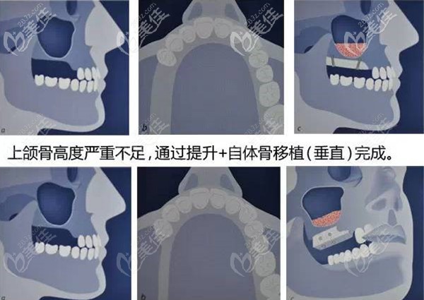 上頜竇提升手術(shù) 上頜竇提升手術(shù)